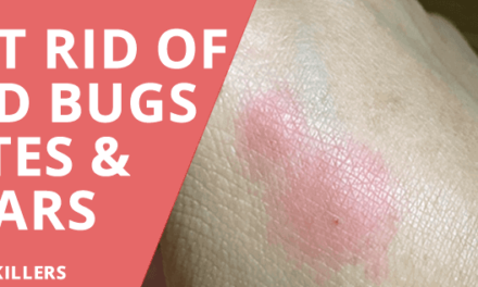 How to Get Rid of Bed Bug Scars and Bites