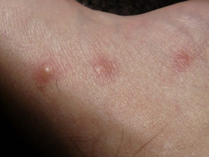 Image of spider bites swell