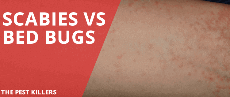 Scabies vs Bed Bugs – Skin Burrowing and Bite Marks