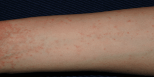 Scabies on Arm